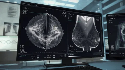 Tomosintezin üstünlüyü nədir? Süd vəzi diaqnostikasında 3D görüntüləmənin rolu