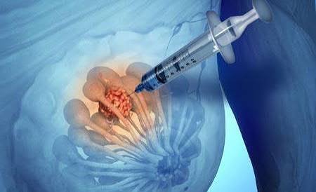 Döş biopsiyası