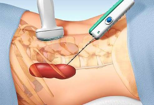 Döş biopsiyasında diaqnostik dəqiqlik: cərrahi patologiya ilə müqayisə