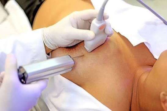 Süd vəzi biopsiyası nədir?
