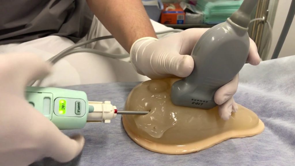 Süd vəzi biopsiyası