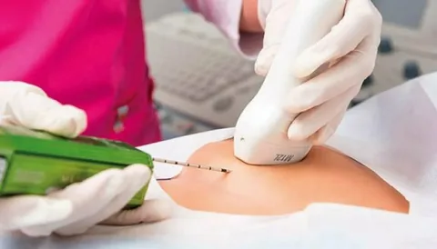 Vakum dəstəkli biopsiya